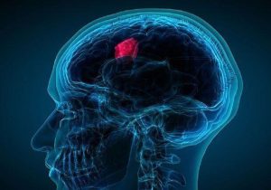 شایع‌ترین علائم تومور مغزی چیست؟